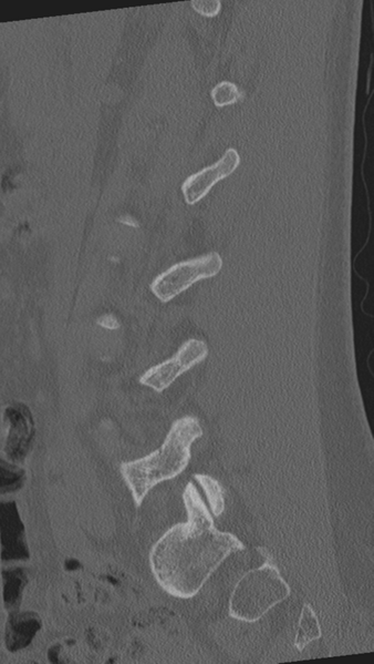 File:Normal lumbar spine CT (Radiopaedia 46533-50986 Sagittal bone window 66).png