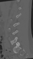 Normal lumbar spine CT (Radiopaedia 46533-50986 Sagittal bone window 66).png