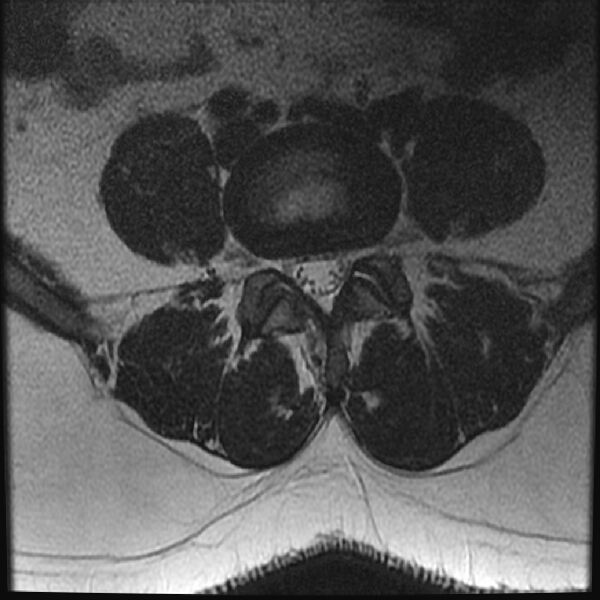 File:Normal lumbar spine MRI (Radiopaedia 43051-46311 Axial T2 19).jpg