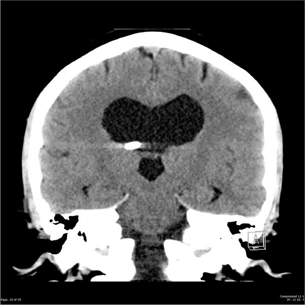 File:Normal pressure hydrocephalus (Radiopaedia 24415-24736 Coronal non-contrast 16).jpg