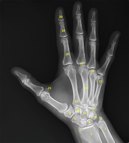 File:Normal radiographic anatomy of the hand (Radiopaedia 42878-46095 B 1).jpg