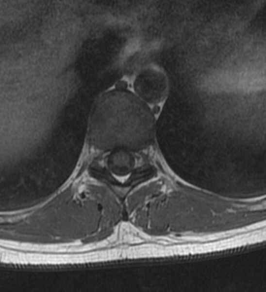 File:Normal thoracic spine MRI (Radiopaedia 41033-43781 Axial T1 13).jpg