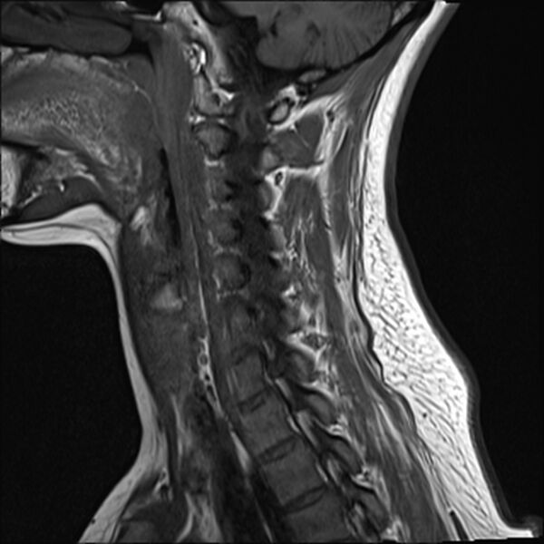 File:Normal trauma cervical spine MRI (Radiopaedia 32130-33071 Sagittal T1 11).jpg