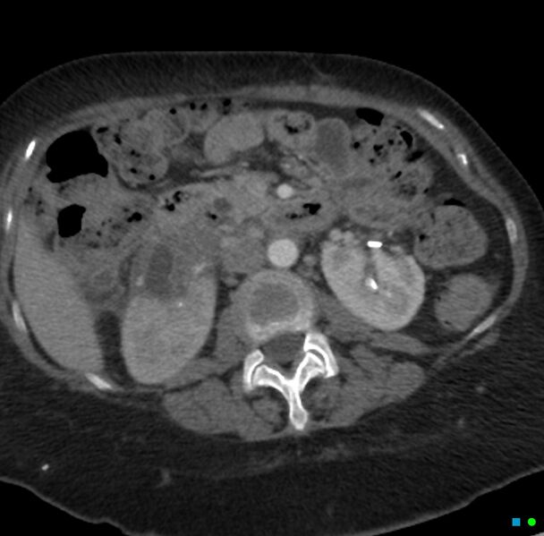 File:Obstructed infected horseshoe kidney (Radiopaedia 18116-17898 B 10).jpg