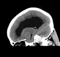Obstructive hydrocephalus (Radiopaedia 30453-31119 C 12).jpg