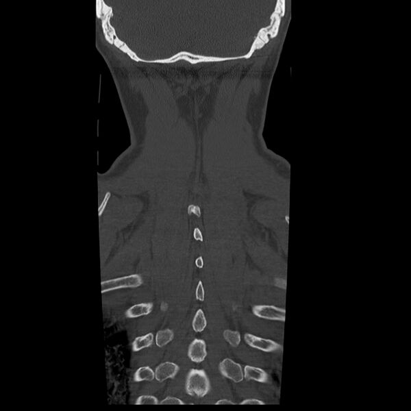 File:Occipital condyle fracture (Radiopaedia 31755-32691 Coronal bone window 34).jpg