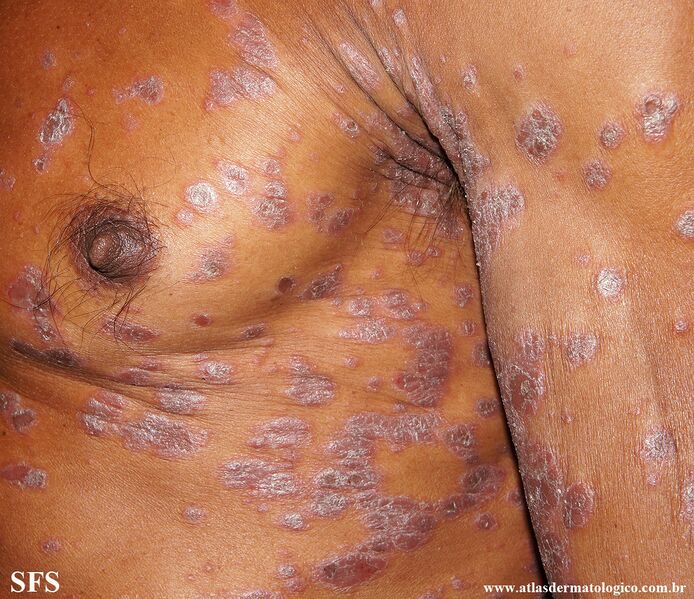 File:Psoriasis (Dermatology Atlas 138).jpg