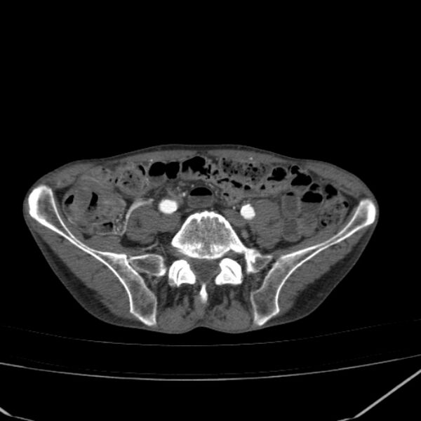 File:Abdominal aortic aneurysm (Radiopaedia 23703-23856 Axial C+ arterial phase 67).jpg