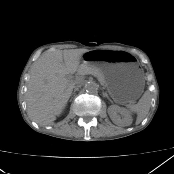 File:Abdominal aortic aneurysm (Radiopaedia 23703-23856 Axial non-contrast 15).jpg