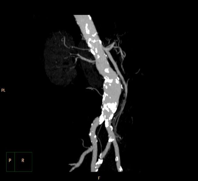 File:Abdominal aortic aneurysm (Radiopaedia 23703-23856 MIP 9).jpg