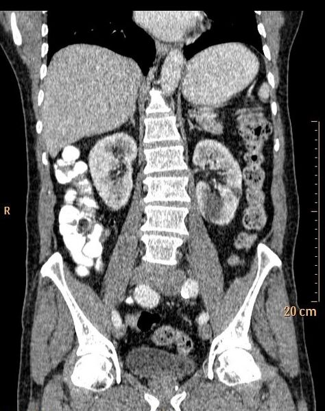 File:Abdominal aortic aneurysm (Radiopaedia 25985-26121 Coronal C+ arterial phase 23).jpg