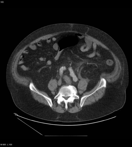 File:Abdominal aortic aneurysm with intramural hematoma then rupture (Radiopaedia 50278-55631 Axial C+ arterial phase 94).jpg