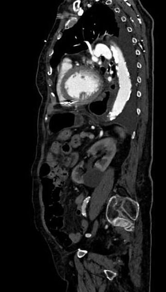 File:Abdominal aortic aneurysm with thrombus fissuration (Radiopaedia 73192-83919 Sagittal C+ arterial phase 43).jpg