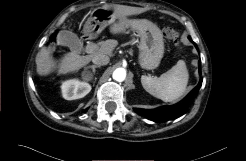 File:Abdominal aortic interposition tube graft and aneurysm thrombosis (Radiopaedia 71438-81857 Axial C+ arterial phase 13).jpg