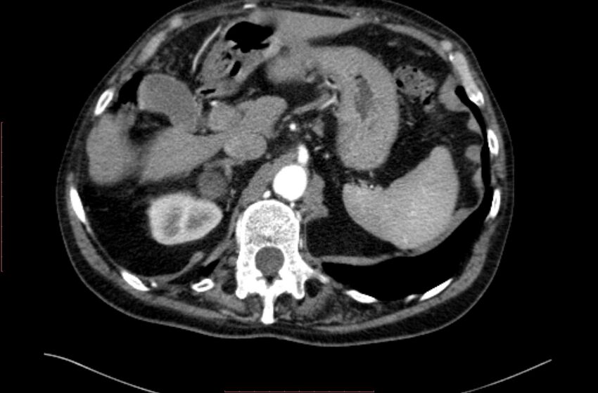 Abdominal aortic interposition tube graft and aneurysm thrombosis (Radiopaedia 71438-81857 Axial C+ arterial phase 13).jpg