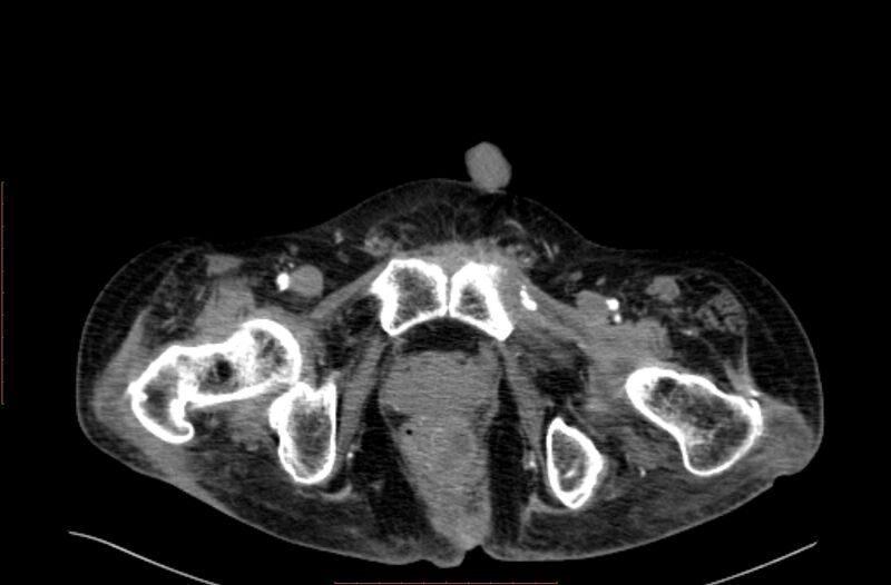 File:Abdominal aortic interposition tube graft and aneurysm thrombosis (Radiopaedia 71438-81857 Axial C+ arterial phase 249).jpg