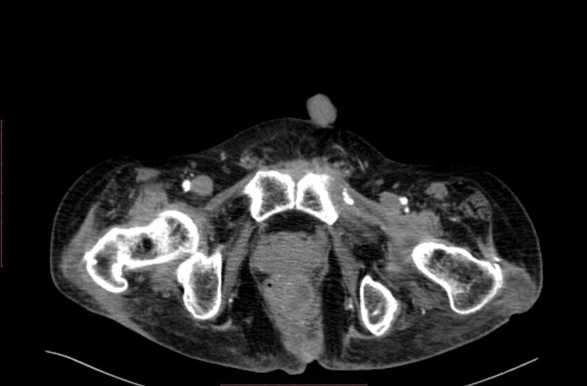 Abdominal aortic interposition tube graft and aneurysm thrombosis (Radiopaedia 71438-81857 Axial C+ arterial phase 249).jpg