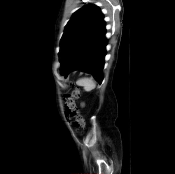 File:Abdominal aortic interposition tube graft and aneurysm thrombosis (Radiopaedia 71438-81857 Sagittal C+ arterial phase 2).jpg