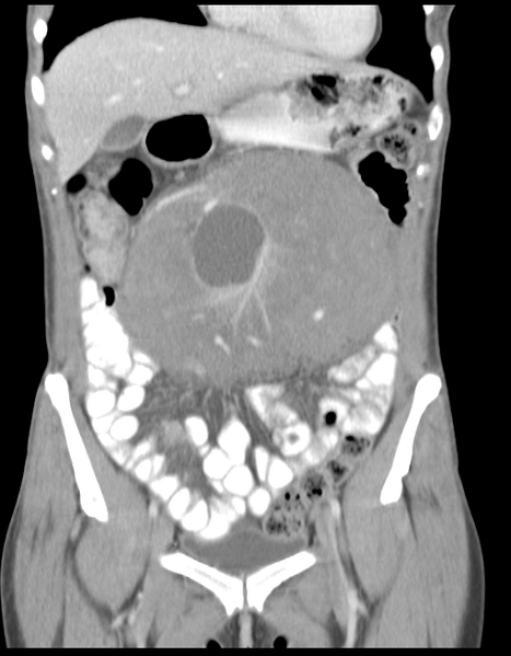 File:Abdominal desmoid tumor (Radiopaedia 41007-43740 Coronal C+ portal venous phase 14).png