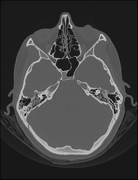 File:Aberrant right internal carotid artery (Radiopaedia 65191-74198 Axial non-contrast 55).jpg
