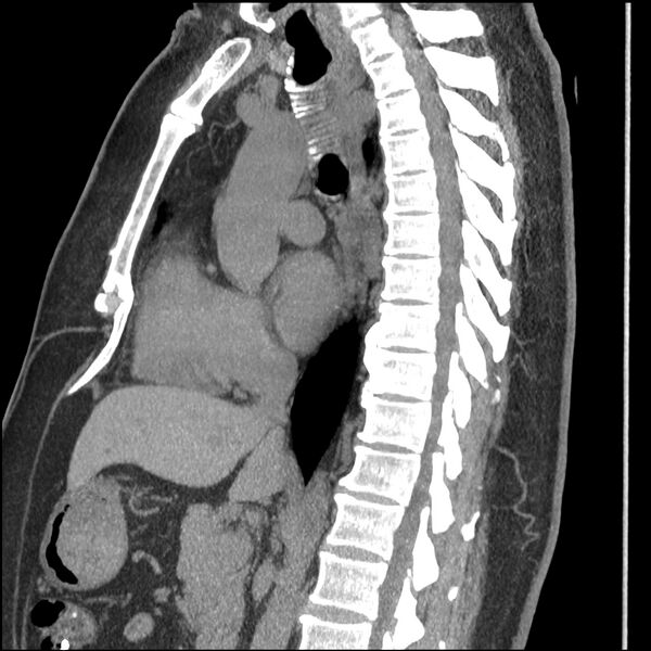 File:Aberrant right subclavian artery (Radiopaedia 40967-43680 Sagittal non-contrast 44).jpg