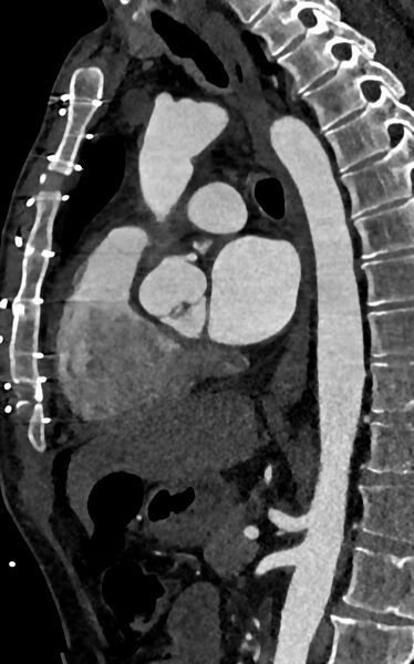 File:Accessory left atrial appendage (Radiopaedia 81987-95968 Sagittal C+ arterial phase 63).jpg