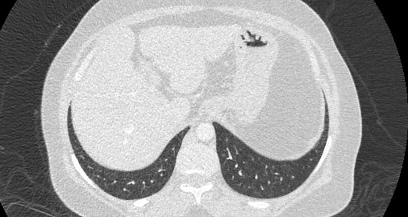 File:Accessory right inferior hepatic vein (Radiopaedia 65245-74259 Axial lung window 69).jpg