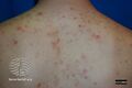 Acne affecting the back images (DermNet NZ acne-acne-back-183).jpg
