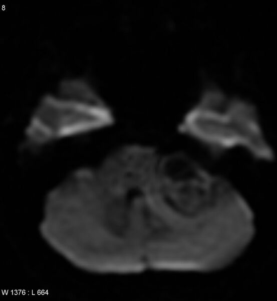 File:Acoustic schwannoma (large with cystic change) (Radiopaedia 5369-7130 Axial DWI 1).jpg