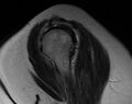 Acromioclavicular arthritis - rotator cuff tear (Radiopaedia 10890-11321 Sagittal T2 1).jpg