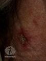 Actinic Keratoses treated with imiquimod (DermNet NZ lesions-ak-imiquimod-3767).jpg
