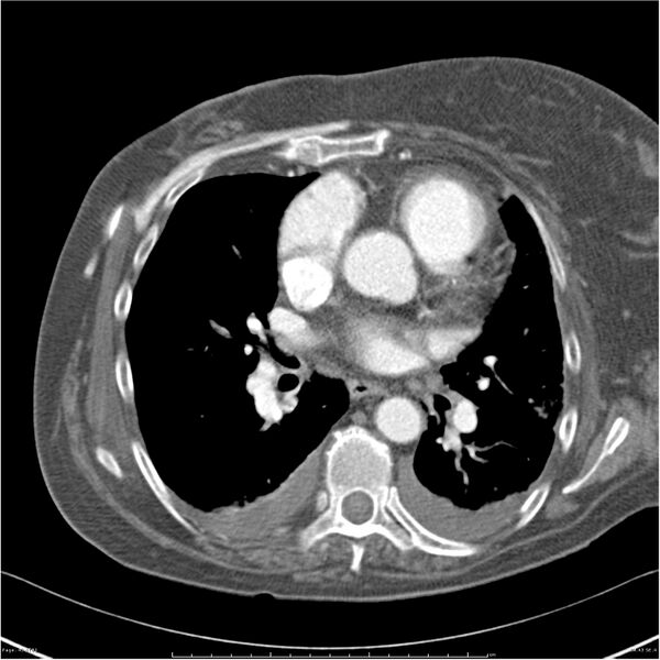 File:Acute-on-chronic pulmonary emboli (Radiopaedia 27925-28169 C+ CTPA 43).jpg