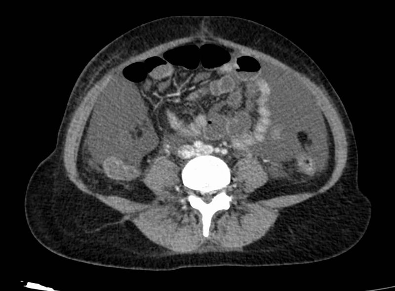 File:Acute Budd-Chiari syndrome (Radiopaedia 60858-68638 Axial C+ portal venous phase 191).jpg