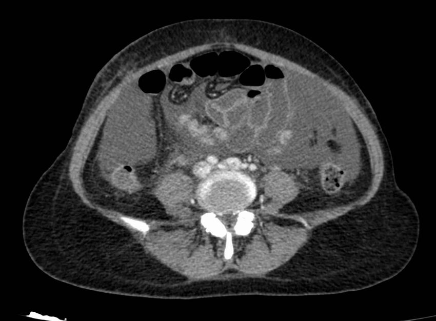 Acute Budd-Chiari syndrome (Radiopaedia 60858-68638 Axial C+ portal venous phase 197).jpg