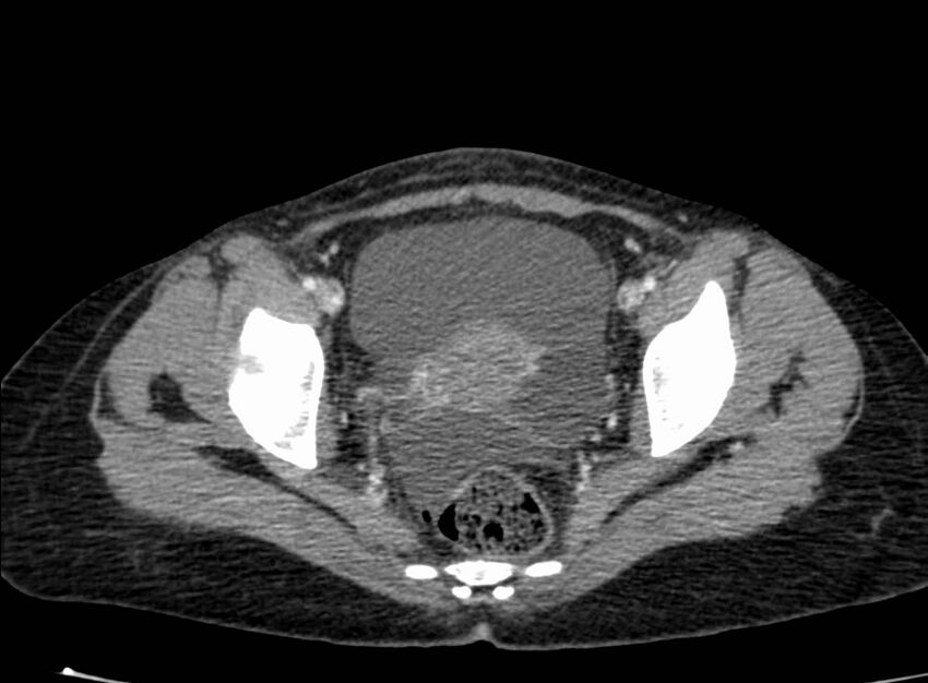 Acute Budd-Chiari syndrome (Radiopaedia 60858-68638 Axial C+ portal venous phase 269).jpg