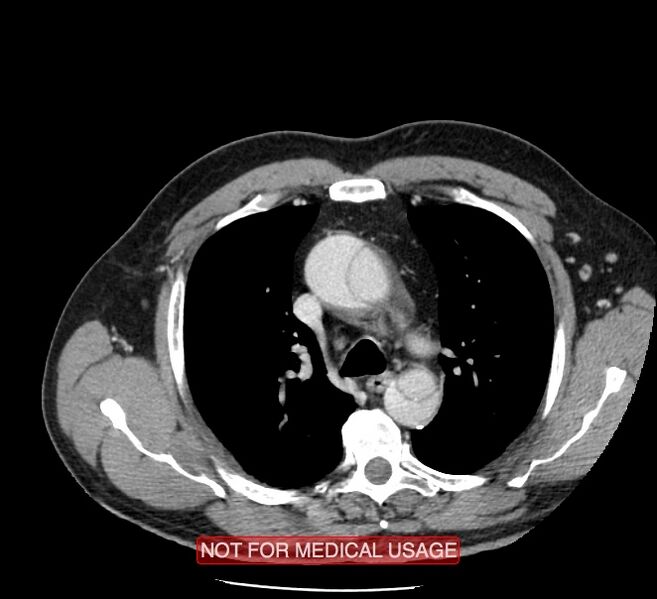 File:Acute aortic dissection - Stanford type A (Radiopaedia 40661-43285 Axial C+ portal venous phase 11).jpg