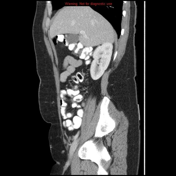 File:Acute appendicitis (Radiopaedia 7966-8812 B 7).jpg