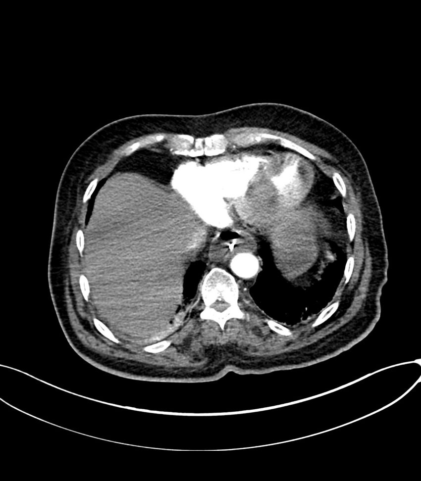 Acute arterial mesenteric ischemia (Radiopaedia 78238-90828 Axial C+ arterial phase 21).jpg