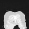 Acute aspiration pneumonitis (Radiopaedia 33605-34703 Coronal lung window 8).jpg