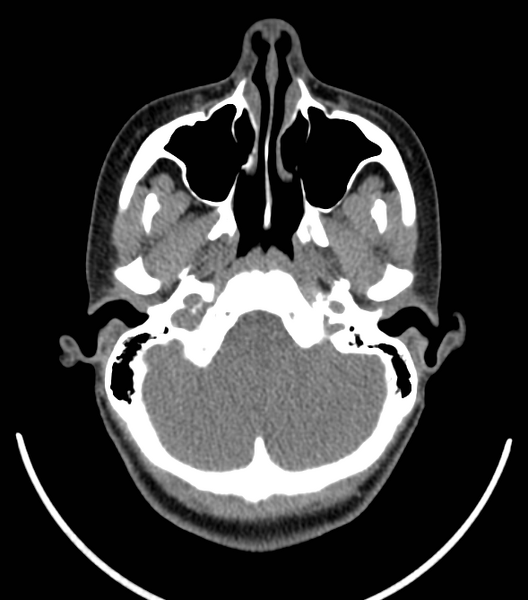 File:Acute bacterial tonsillitis (Radiopaedia 22882-22908 Axial non-contrast 2).png