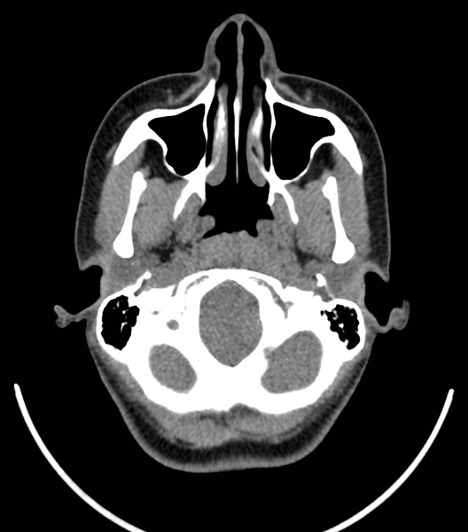 File:Acute bacterial tonsillitis (Radiopaedia 22882-22908 Axial non-contrast 5).png