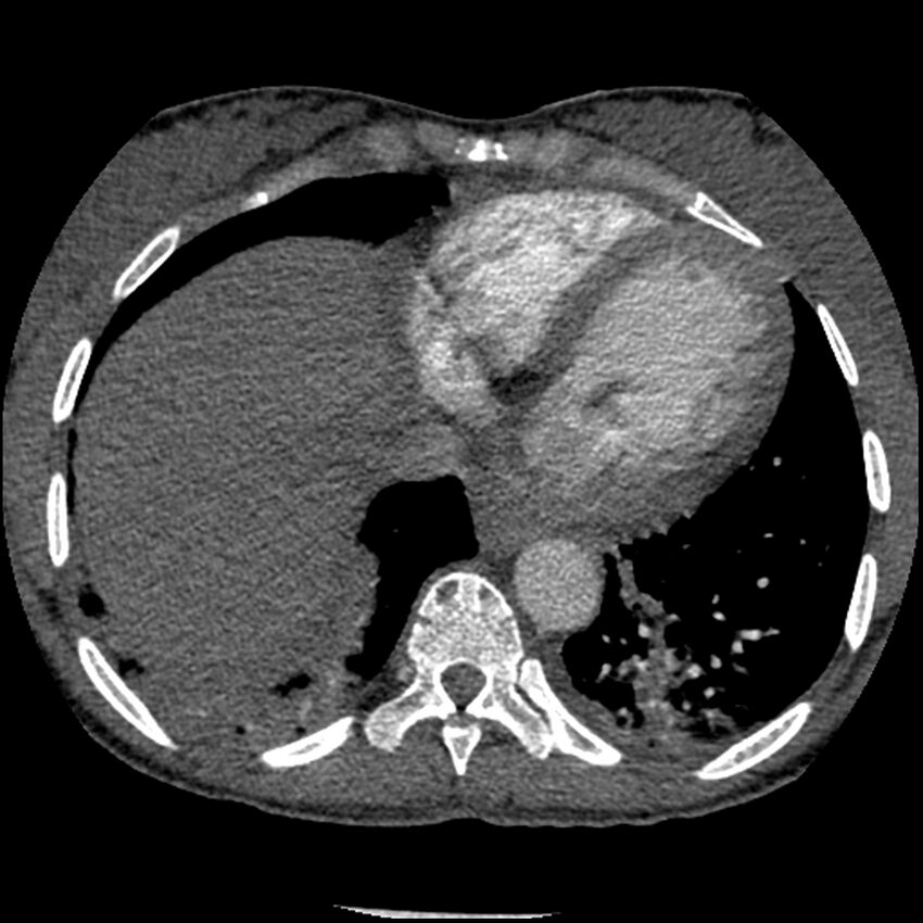 Acute chest syndrome - sickle cell disease (Radiopaedia 42375-45499 Axial C+ CTPA 145).jpg