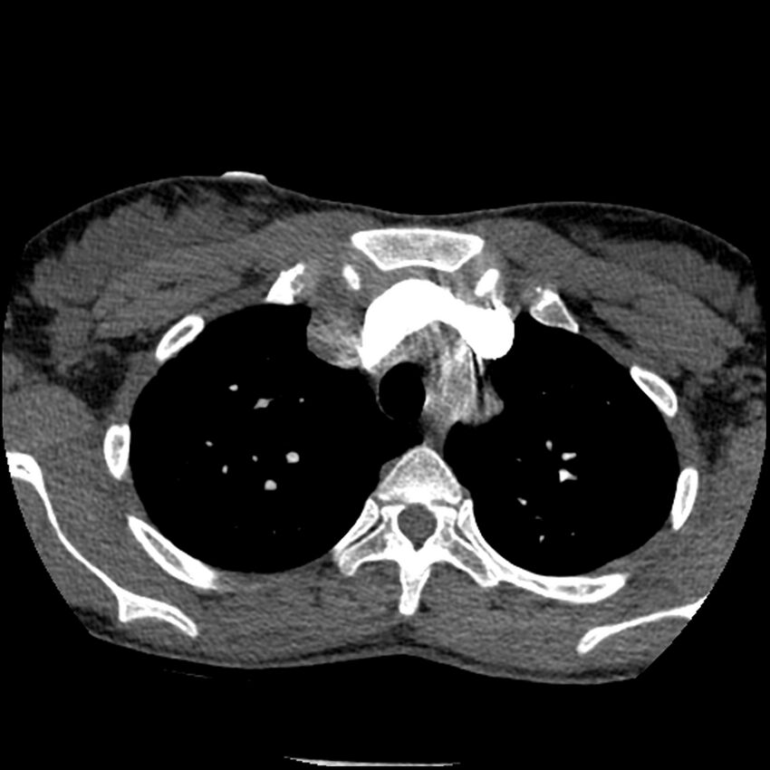 Acute chest syndrome - sickle cell disease (Radiopaedia 42375-45499 Axial C+ CTPA 44).jpg