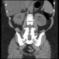 Acute cholecystitis and ureteric colic (Radiopaedia 42330-45444 Coronal prone 72).jpg