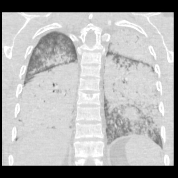 File:Acute diffuse alveolar hemorrhage (Radiopaedia 41323-44158 Coronal lung window 43).jpg