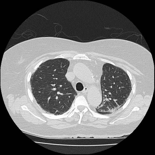 File:Acute interstitial pneumonitis (Radiopaedia 45404-49452 Axial lung window 30).jpg