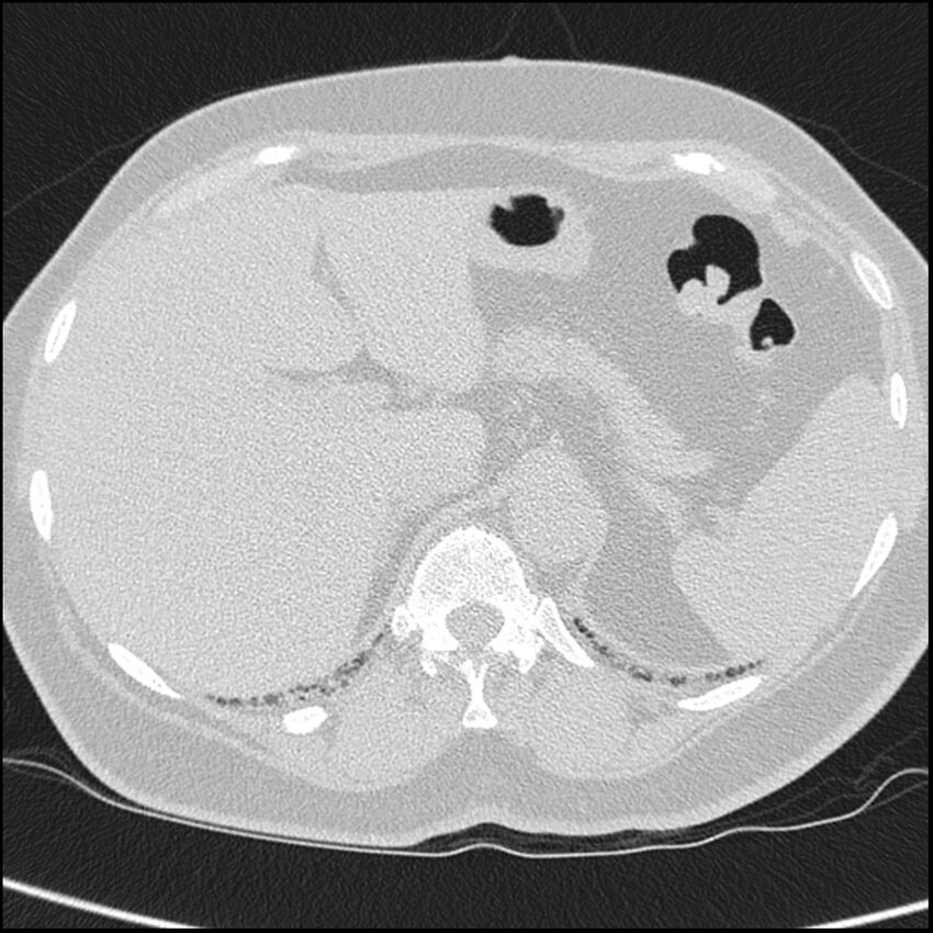 Acute interstitial pneumonitis (Radiopaedia 45404-49453 Axial lung window 77).jpg