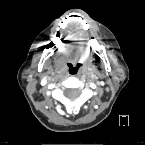 File:Acute left parotid sialadenitis (Radiopaedia 26160-26295 C+ arterial phase 21).jpg
