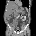 Acute pancreatitis (Radiopaedia 19135-19116 Coronal non-contrast 19).jpg