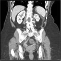 Acute pancreatitis (Radiopaedia 19136-19117 Coronal C+ portal venous phase 30).jpg
